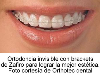 Ortodoncia invisible con brackets de zafiro. Foto cortesía de Orthotec dental