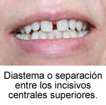 Diastema o separación entre los incisivos centrales superiores.