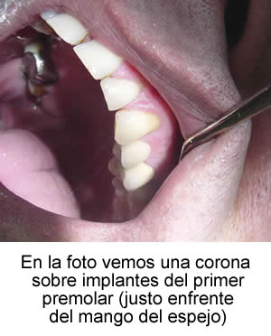 En la foto vemos una corona sobre implantes del primer premolar (justo enfrente del mango del espejo)