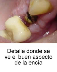 Detalle donde se ve el buen aspecto de la encía