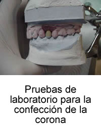 Pruebas de laboratorio para la confección de la corona