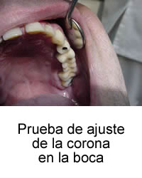 Prueba de ajuste de la corona en la boca