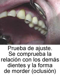 Prueba de ajuste. Se comprueba la relación con los demás dientes y la forma de morder (oclusión)