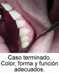 Caso terminado. Color, forma y función adecuados.