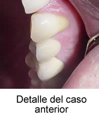 Detalle del caso anterior