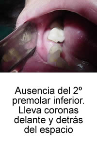 Ausencia del 2º premolar inferior. Lleva coronas delante y detrás del espacio.