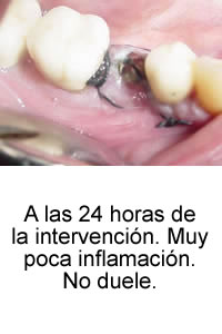 A las 24 horas de la intervención. Muy poca inflamación. No duele.
