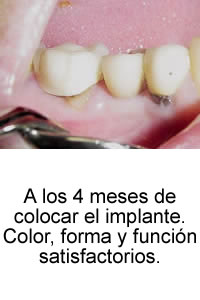A los 4 meses de colocar el implante. Color, forma y función satisfactorios.