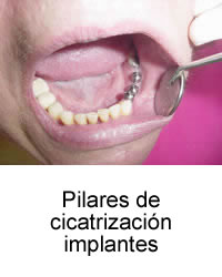Pilares de cicatrización implantes