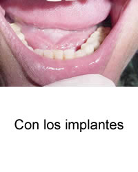 Con los implantes