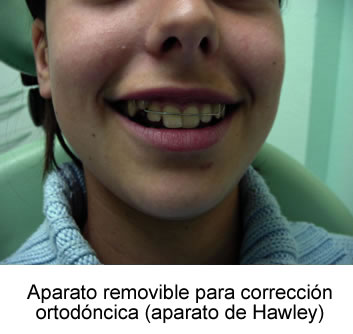 Aparato removible para corrección ortodóncica (aparato de Hawley)