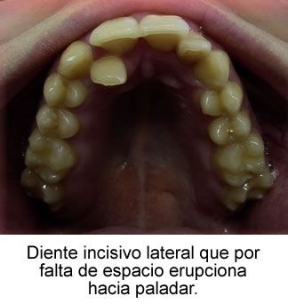 Diente incisivo lateral que por falta de espacio erupciona hacia paladar.