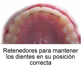 Retenedores para mantener los dientes en su posición correcta