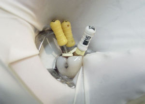 qu&eacute; es una ondodoncia 06